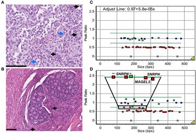 Register-based and genetic studies of Prader-Willi syndrome show a high frequency of gonadal tumors and a possible mechanism for tumorigenesis through imprinting relaxation